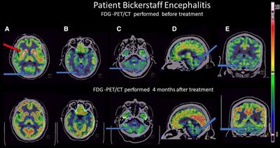 Case report: 18F-FDG PET-CT findings in Bickerstaff encephalitis before and after treatment
